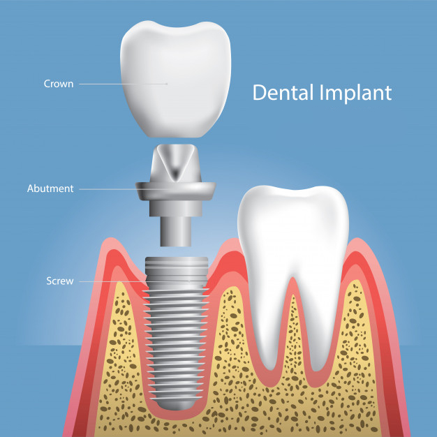 Crown, abutment, dental implant